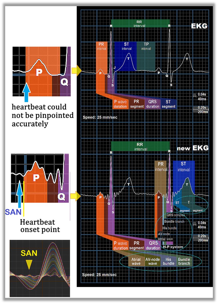 SAN (sinoatrial node)

Precisely locating the starting point of each heartbeat is extremely difficult and has been a challenge for 122 years. The reason is that the P-wave onset in traditional ECGs is a curved corner, and a slight difference amounts to 5–10 milliseconds.