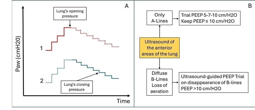 🫁▪️Ultrasonido pulmonar en la evaluación y manejo de pacientes con ventilación mecánica.📜
▪️🫁- El protocolo BLUE identifica condiciones pulmonares en el 90% de los casos.  
▪️🫁- Un LUS ≥ 18 indica la necesidad de intubación en pacientes con enfermedades pulmonares