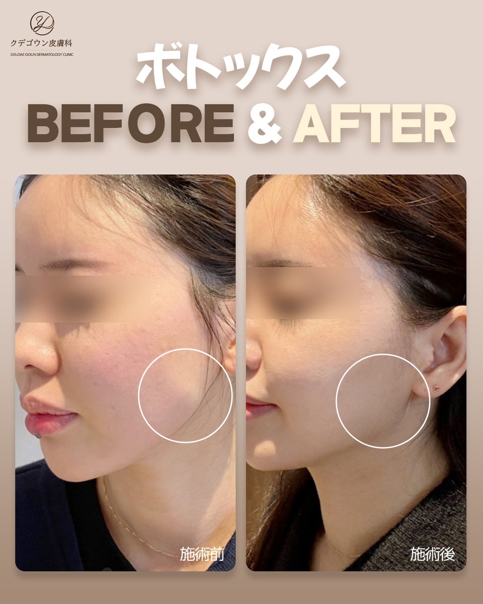 クデゴウン皮膚科のボトックスは、ナチュラルで綺麗なボリュームを作ります🫢

💉ボトックスとは？
ボツリヌストキシンというバクテリアから分泌される毒素を、人体に
安全に使用できるよう精製して製造した、筋肉収縮注射剤です。
