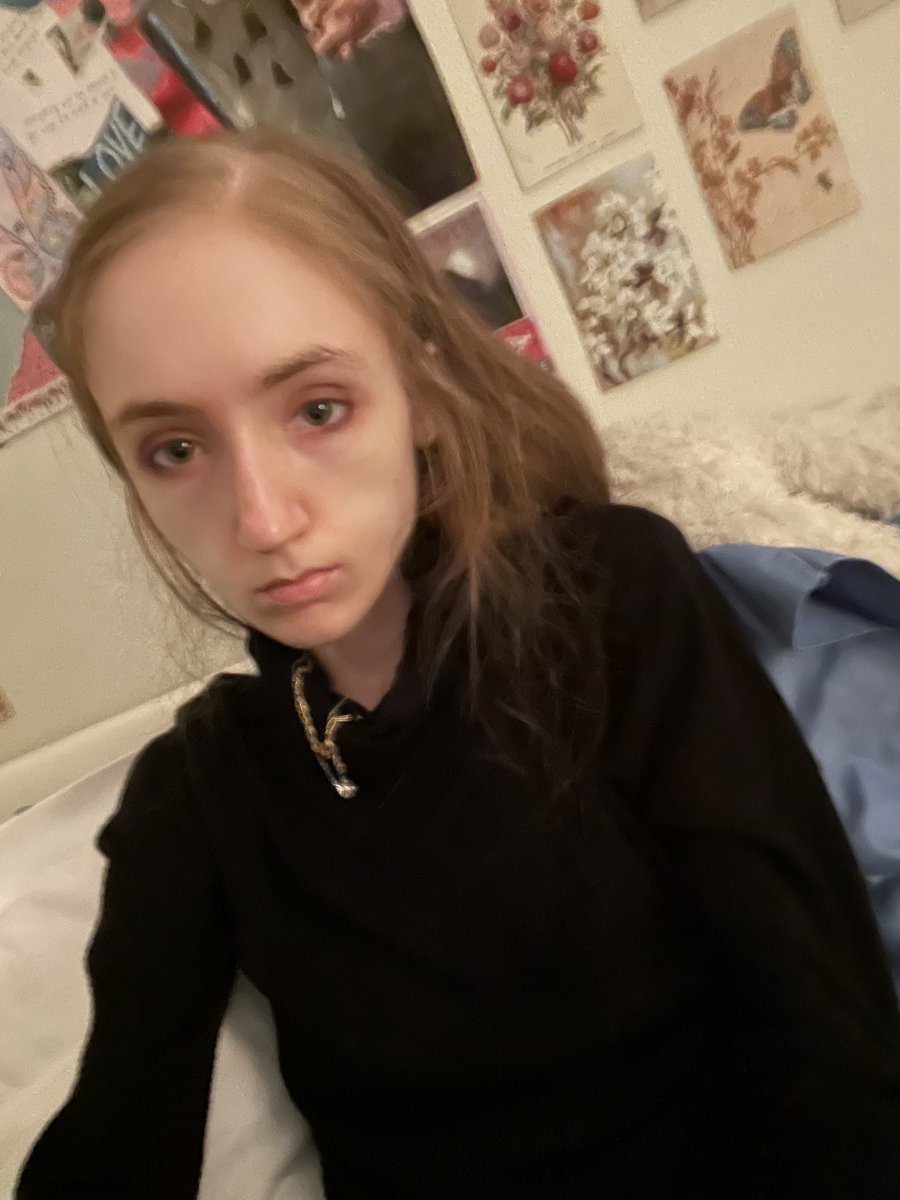alexaceack's tweet photo. I'm Alexa, diagnosed with ana for 11 yrs. I reached my lowest weight in 2023, but I completely lost my ability to walk, was in and out of the ICU, out of state hospitals and residential. they made me gain, so I've been trying to get back to my lowest. https://t.co/xwI1xJ3ZAM