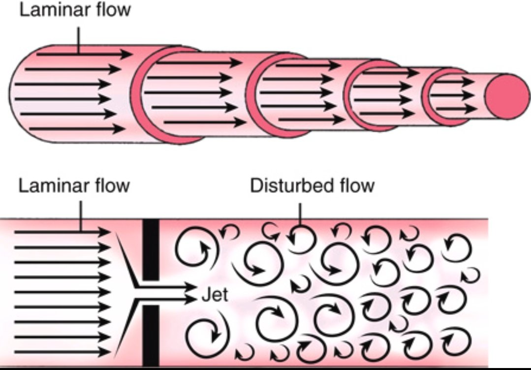 Understanding Intracardiac Blood Flow: Laminar vs. Disturbed Flow

Blood flow in the heart follows distinct patterns, influencing hemodynamics and disease progression.

🔹 Laminar Flow (Top Image) – Smooth, parallel streamlines with uniform velocity, seen in normal arteries and