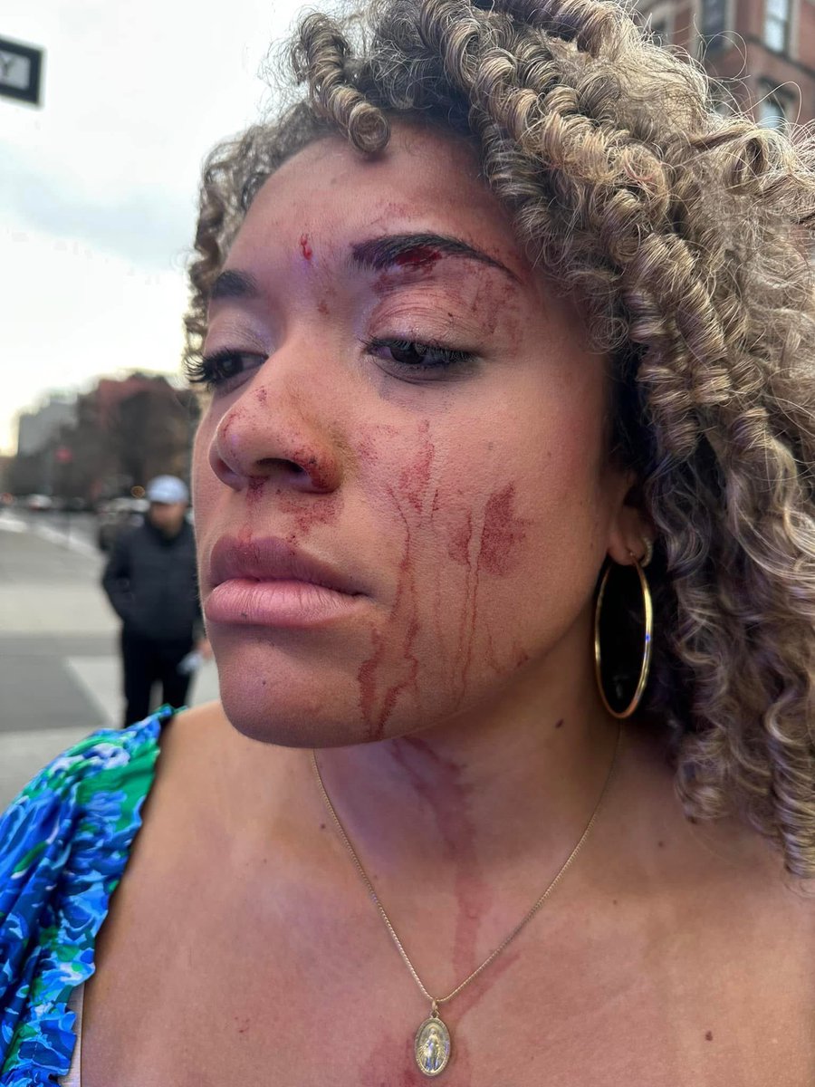 ÚLTIMA HORA 🚨.

Savannah Craven, una defensora pro-vida que trabaja con Live Action, fue golpeada en múltiples ocasiones, por una partidaria a favor del aborto en Nueva York.

En oración por Savannah, que ahora está en el hospital.