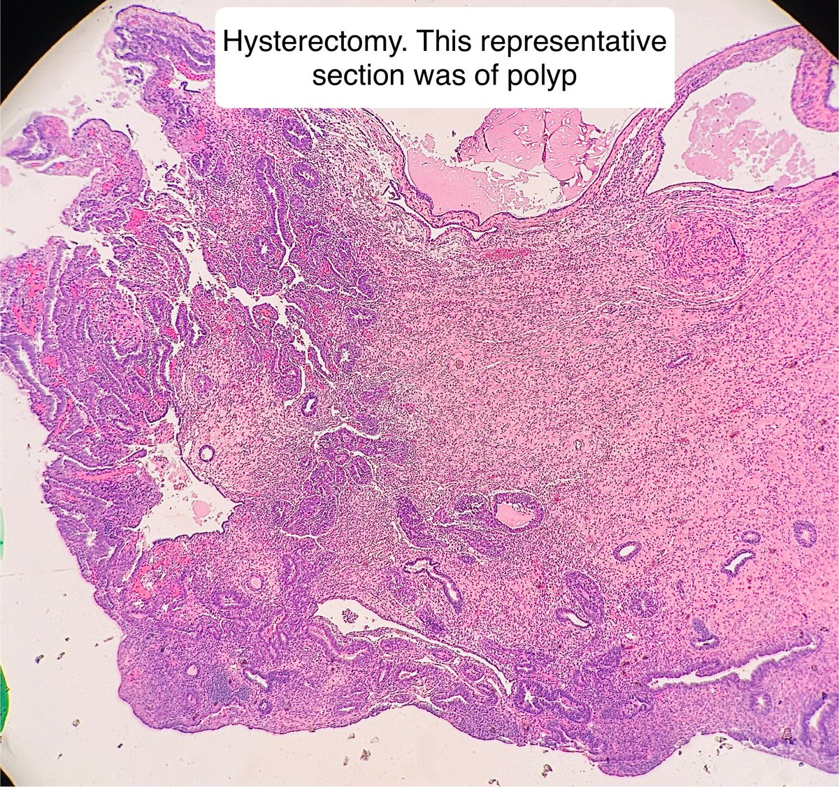 Path4People's tweet image. 63 y/o post menopausal woman with abnormal uterine bleeding 🩸 

Imaging found a polyp. 

Biopsy and subsequent hysterectomy done. Sample of polyp 👇 

IHC: p53 mutant, p16 diffuse. 

Dx? 🤔 #gynpath #gynonc #pathx
