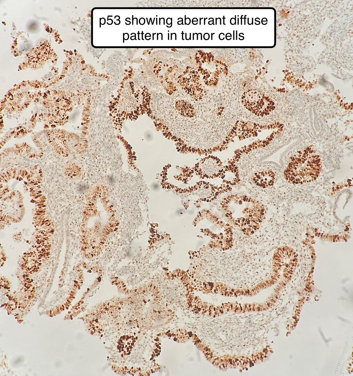 Path4People's tweet image. 63 y/o post menopausal woman with abnormal uterine bleeding 🩸 

Imaging found a polyp. 

Biopsy and subsequent hysterectomy done. Sample of polyp 👇 

IHC: p53 mutant, p16 diffuse. 

Dx? 🤔 #gynpath #gynonc #pathx