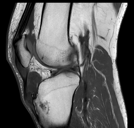 MSK Teaching Room (@mskteachingroom) on Twitter photo Select load dicom viewer to see case π
<a href="/jacja_/">JJ</a> <a href="/drvenkimdrd/">Venkatesh Mβ―οΈ</a> <a href="/veronica_giotas/">Veronica Giotas (Attard)</a> <a href="/mskradiologyuk/">Professor Harun Gupta</a> <a href="/SidThakerMSK/">Siddharth Thaker (Thee/Thou/Thine)</a>
#orthotwitter
Snippets below: Select load dicom viewer to see case π
<a href="/jacja_/">JJ</a> <a href="/drvenkimdrd/">Venkatesh Mβ―οΈ</a> <a href="/veronica_giotas/">Veronica Giotas (Attard)</a> <a href="/mskradiologyuk/">Professor Harun Gupta</a> <a href="/SidThakerMSK/">Siddharth Thaker (Thee/Thou/Thine)</a>
#orthotwitter
Snippets below:
