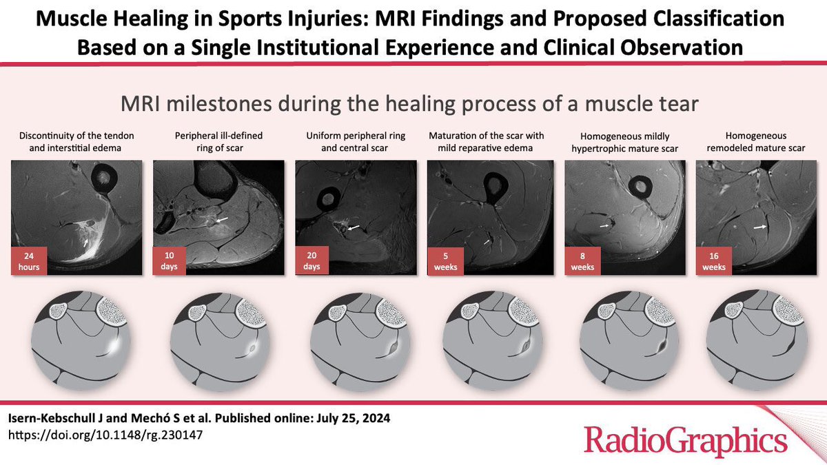 Recently, there’s been growing debate around whether athletes should delay return to play (RTP) until the final scar maturation stage is reached.

We addressed this dilemma in our <a href="/RadioGraphics/">RadioGraphics</a> (2024) and <a href="/InsightsImaging/">Insights into Imaging</a> (2021) papers, showing how MRI can support RTP decisions