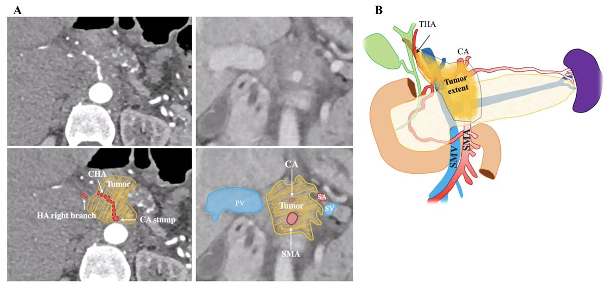 Annals of Surgical Oncology (@annsurgoncol) on Twitter photo April Issue: Two-Stage Mayo Clinic Class IIIb Celiac Axis Resection for #PancreaticAdenocarcinoma : Stepwise Management <a href="/alemarche055/">Alessio Marchetti MD</a> <a href="/CamilaHidalgoS2/">Camila Hidalgo Salinas</a> <a href="/gregDsacks/">Greg Sacks</a>
rdcu.be/egeKV
@Laleh_Melstrom
<a href="/SyedAAhmad5/">Syed A. Ahmad</a> April Issue: Two-Stage Mayo Clinic Class IIIb Celiac Axis Resection for #PancreaticAdenocarcinoma : Stepwise Management <a href="/alemarche055/">Alessio Marchetti MD</a> <a href="/CamilaHidalgoS2/">Camila Hidalgo Salinas</a> <a href="/gregDsacks/">Greg Sacks</a>
rdcu.be/egeKV
@Laleh_Melstrom
<a href="/SyedAAhmad5/">Syed A. Ahmad</a>