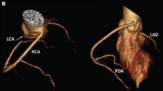 radcliffeCARDIO's tweet image. 📚New #USCJournal Article: "Anomalous Coronary Artery Origin"

📚 Just Published!

🔓Access it here 👉 ow.ly/m8x91064BCj

@CardioNerds #CVImaging #MedEd #CardioEd