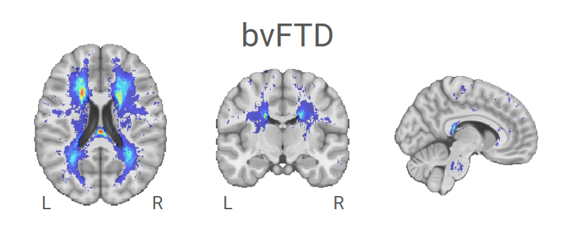 Amelie Metz (@ameliebuh) on Twitter photo Hey #ADPD2025 , I'm happy to present our work on characterizing brain atrophy and cerebrovascular pathology in Frontotemporal Dementia subtypes!
Tomorrow, April 5, 9:40am, Hall F2, session: Mechanisms and Clinical Trials in FTD, ALS, and Neurodegeneration 02 <a href="/adpdnet/">AD/PD - Advances in Science & Therapy</a> Hey #ADPD2025 , I'm happy to present our work on characterizing brain atrophy and cerebrovascular pathology in Frontotemporal Dementia subtypes!
Tomorrow, April 5, 9:40am, Hall F2, session: Mechanisms and Clinical Trials in FTD, ALS, and Neurodegeneration 02 <a href="/adpdnet/">AD/PD - Advances in Science & Therapy</a>