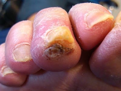 DGArmstrong's tweet photo. Treatment of distal toe calluses and ulcerations https://t.co/NvQWWBILdL 
#lermagazine #toecallus  #ulceration #offloading https://t.co/wTX5AMAvwK