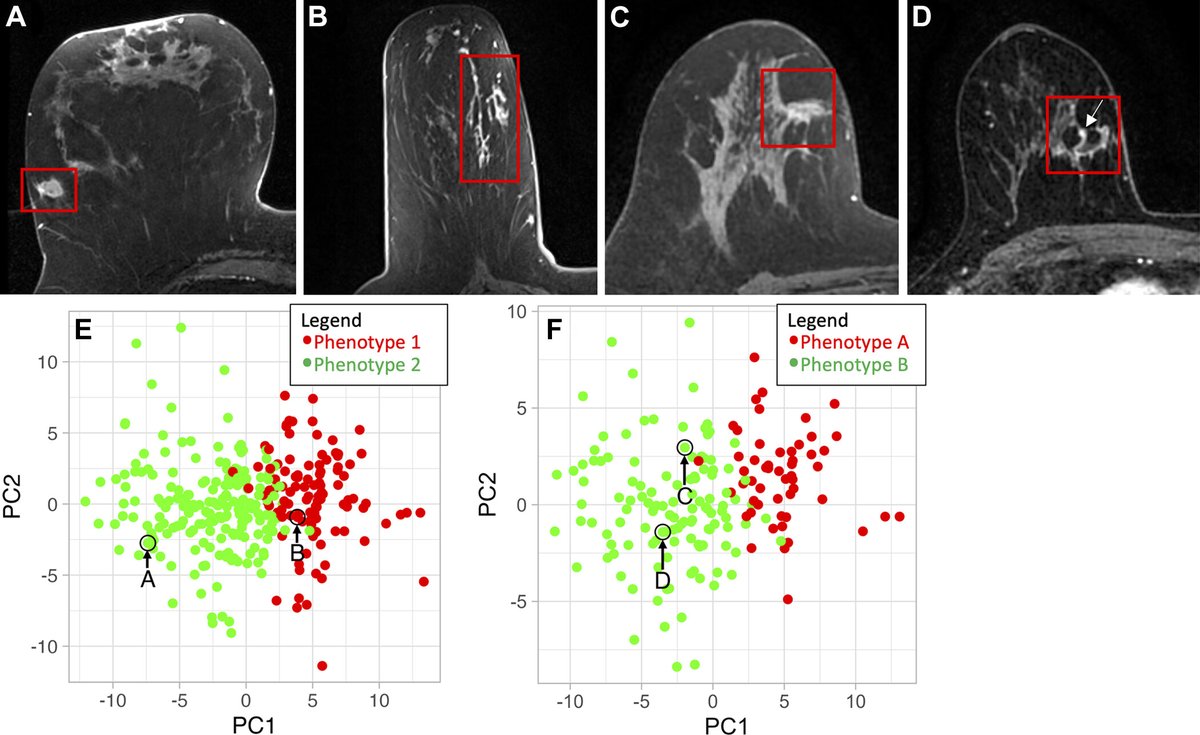 Radiology (@radiology_rsna) on Twitter photo This secondary analysis examines the predictive value of clinical and MRI-based radiomics features for ductal carcinoma in situ (DCIS) disease upstaging at surgery vs DCIS score. <a href="/columbiaimaging/">Columbia Radiology</a> <a href="/UWMedicine/">UW Medicine</a> <a href="/BrownBiostats/">Brown Biostatistics</a> <a href="/kalina_slavkova/">Kalina P. Slavkova</a> <a href="/DespinaKontos/">Despina Kontos</a> bit.ly/3YcDFD8 This secondary analysis examines the predictive value of clinical and MRI-based radiomics features for ductal carcinoma in situ (DCIS) disease upstaging at surgery vs DCIS score. <a href="/columbiaimaging/">Columbia Radiology</a> <a href="/UWMedicine/">UW Medicine</a> <a href="/BrownBiostats/">Brown Biostatistics</a> <a href="/kalina_slavkova/">Kalina P. Slavkova</a> <a href="/DespinaKontos/">Despina Kontos</a> bit.ly/3YcDFD8