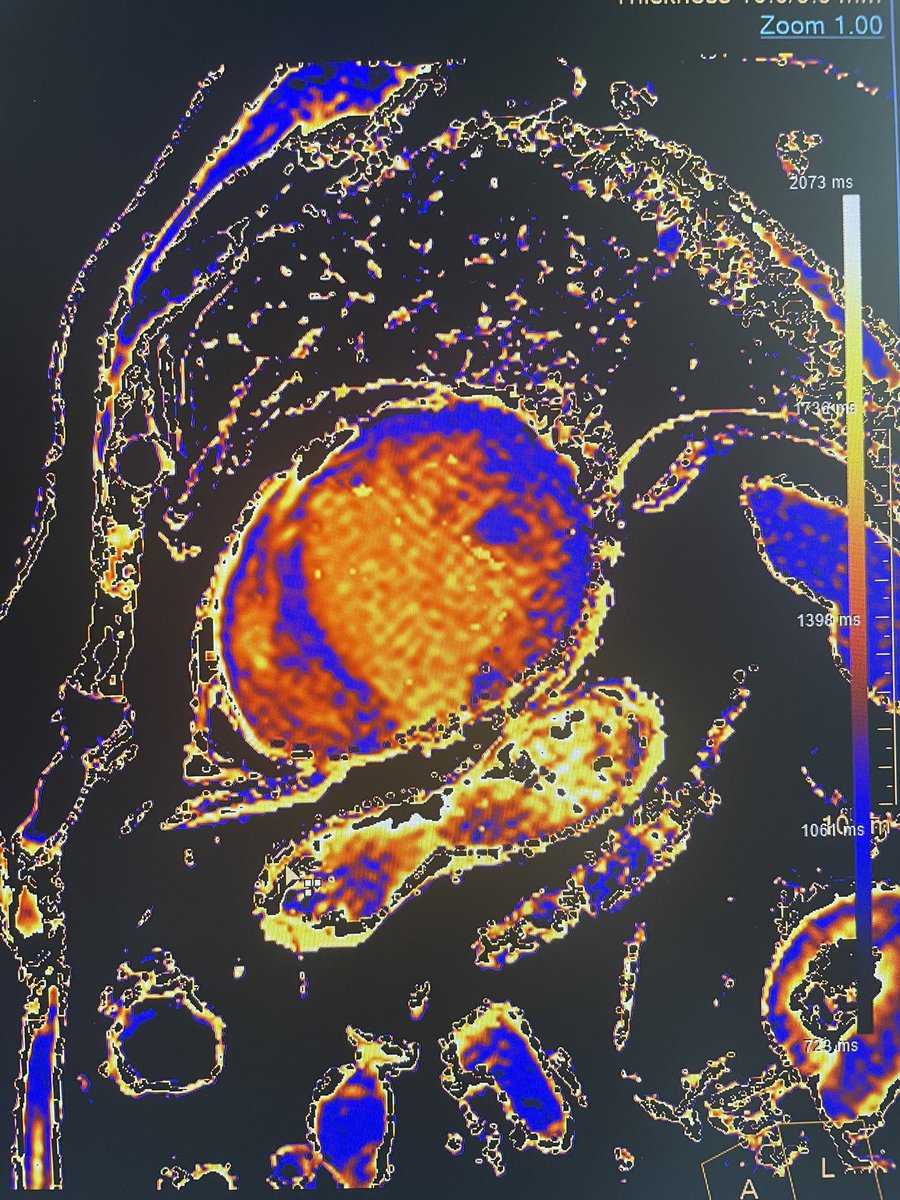 FedericaFras's tweet photo. Male, 71 yo
Admitted for heart failure
History of non obstructive HCM  
LBBB at EKG
CMR: severe dilatation, EF 15%, midwall LGE, ECV 39%
Diagnosis ⁉️ https://t.co/KMz1um01Xd