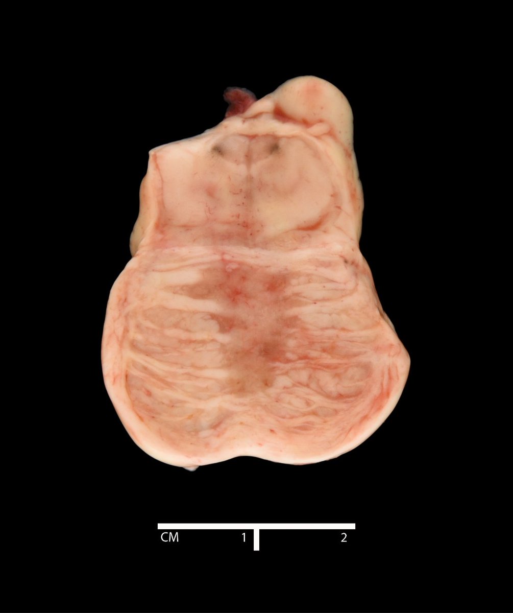 Case of the week by Eleni Constantopoulos, Drs. Ross Reichard &amp; Ross Zumwalt, Mayo Clinic: A 61-year-old man was found dead in his secured home. What was found at the scene of death? surveymonkey.com/r/X3BPZVL