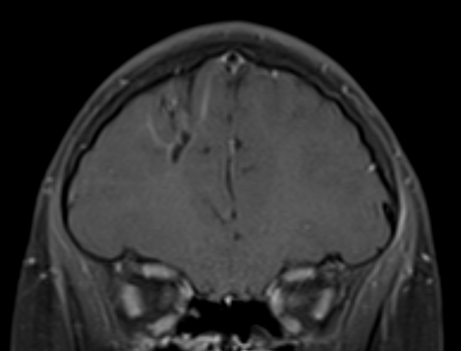 It's time to share this week's #SPIN-#POV. Developmental Venous Anomalies (DVA) can thrombose and bleed, not always benign in character these lesions! Would you still do a DSA here- share your #POV..