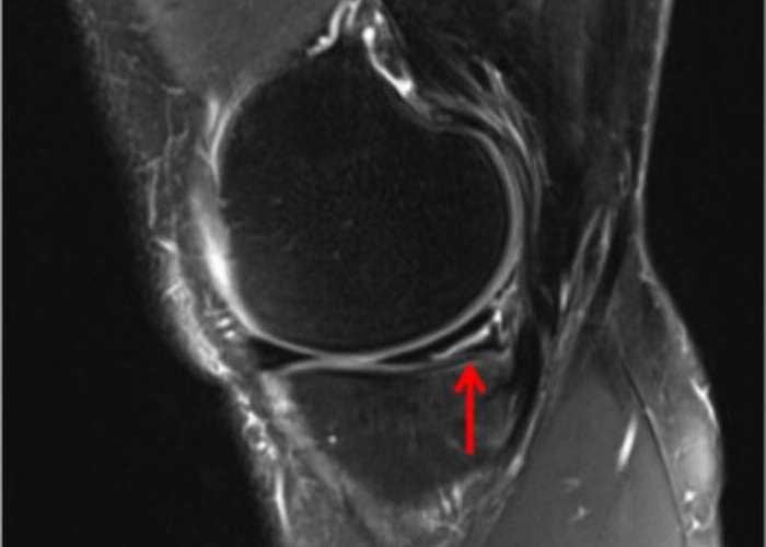thekneedoc's tweet image. When should you consider surgery for a #meniscustear? If you’re feeling pain while twisting, squatting, or have a complex tear (meniscocapsular, radial), surgery may be necessary. #MeniscusRepair can help prevent arthritis &amp;amp; further knee damage!
More info: medilink.us/7sy4