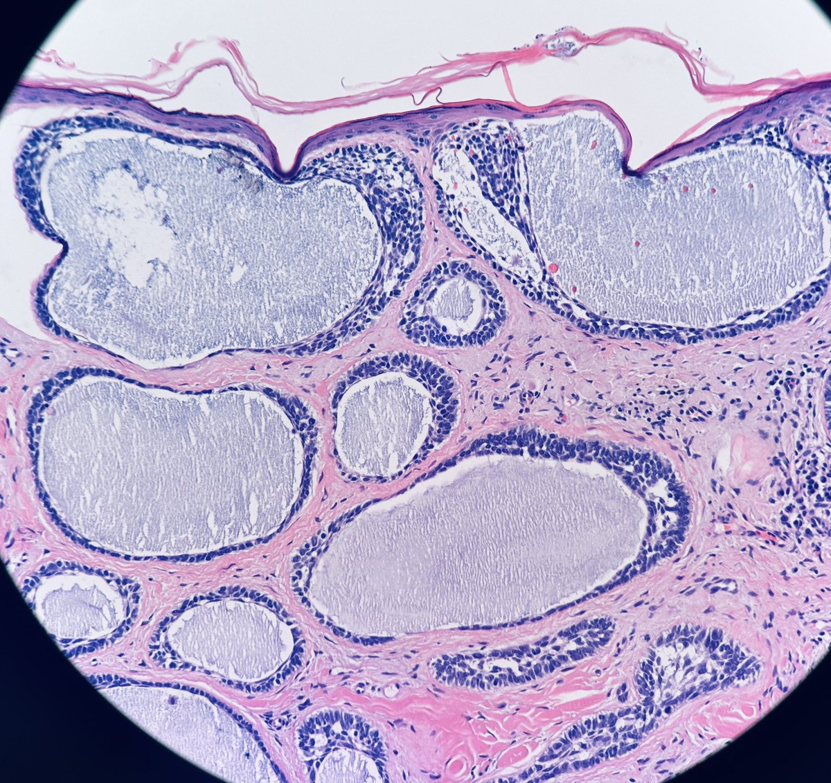 Henry YANG (@henryy_md) on Twitter photo Red or Blue… this is not the color of those two parties in America. Basal cell carcinoma too can be fancy with color preference 😜😂。#dermpath
Red: amyloid deposition, Blue: mucin
<a href="/tonitatirado/">Mariantonieta Tirado</a> <a href="/david_terrano/">David Terrano</a> <a href="/VHNguyenMD/">Van-Hung Nguyen MD 🇺🇦🌻</a> <a href="/MarcelaSaebL/">Marcelasaeblima.</a> Red or Blue… this is not the color of those two parties in America. Basal cell carcinoma too can be fancy with color preference 😜😂。#dermpath
Red: amyloid deposition, Blue: mucin
<a href="/tonitatirado/">Mariantonieta Tirado</a> <a href="/david_terrano/">David Terrano</a> <a href="/VHNguyenMD/">Van-Hung Nguyen MD 🇺🇦🌻</a> <a href="/MarcelaSaebL/">Marcelasaeblima.</a>