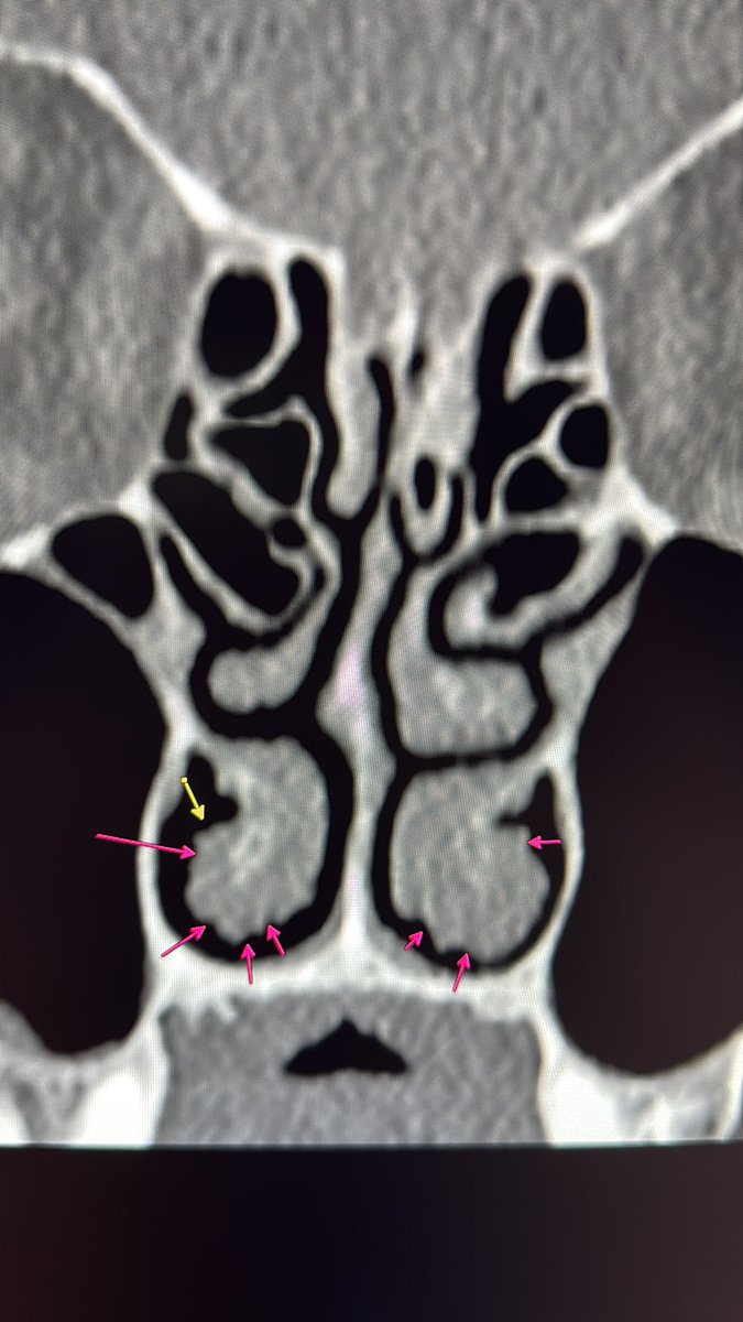 Gul Moonis (@gmoonis) on Twitter photo #hnrad twitter , sinus surgeons , how do you describe this crenulated appearance of the inferior turbinate? Any correlation with symptoms? <a href="/davidgudismd/">David A. Gudis, MD</a> #hnrad twitter , sinus surgeons , how do you describe this crenulated appearance of the inferior turbinate? Any correlation with symptoms? <a href="/davidgudismd/">David A. Gudis, MD</a>