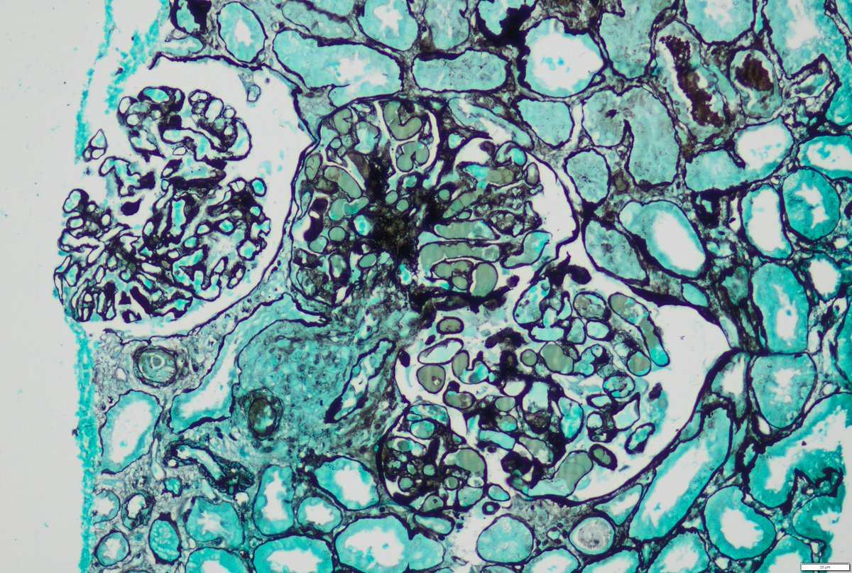 37 y female with hematuria, sub nephrotic range proteinuria and renal dysfunction. Low serum C4 , Serum C3 normal. Biopsy images attached. What special test could be advised to confirm diagnosis. What will be seen on EM?