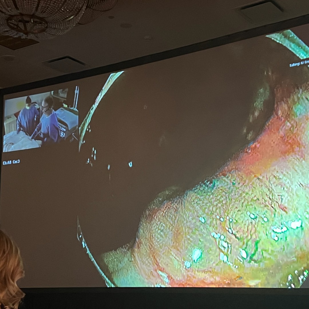 IUGastro's tweet photo. 🚨 Exciting News! 🚨

We hosted the first #liveendoscopy session at #UIGIUpdate! 🎥🔬 Drs. Fatima, Fogel, &amp; @Rex_colonoscopy led a real-time dive into the latest endoscopy breakthroughs! 🌟 A fantastic opportunity for insights &amp; interaction! 🙌 #GITwitter https://t.co/QgnjZmULvi