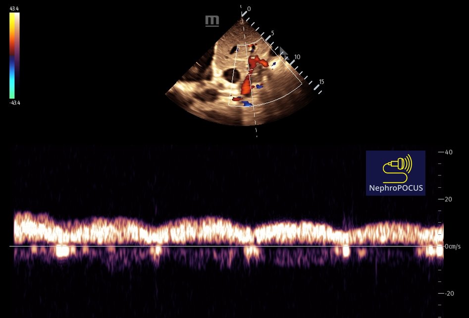 #POCUS #Nephpearls 
While elevated RAP is a key factor in venous congestion (thus a plethoric IVC), quantifying congestion solely based on RAP or IVC diameter isn’t reliable since venous ‘compliance’ should be factored in. I’ve also shared on X/published cases where Doppler