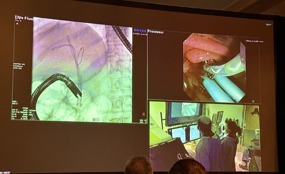 BrettJHoskinsDO's tweet photo. Enjoying the fantastic #LiveEndoscopy sessions at the #IUGIUpdate this morning—triple biliary stent exchange for cholangiocarcinoma, assessing a large recurrent—now cancerous—flat polyp, and cryotherapy for Barrett’s esophagus.

#GITwitter @IUGastro https://t.co/g5Un62NkK6