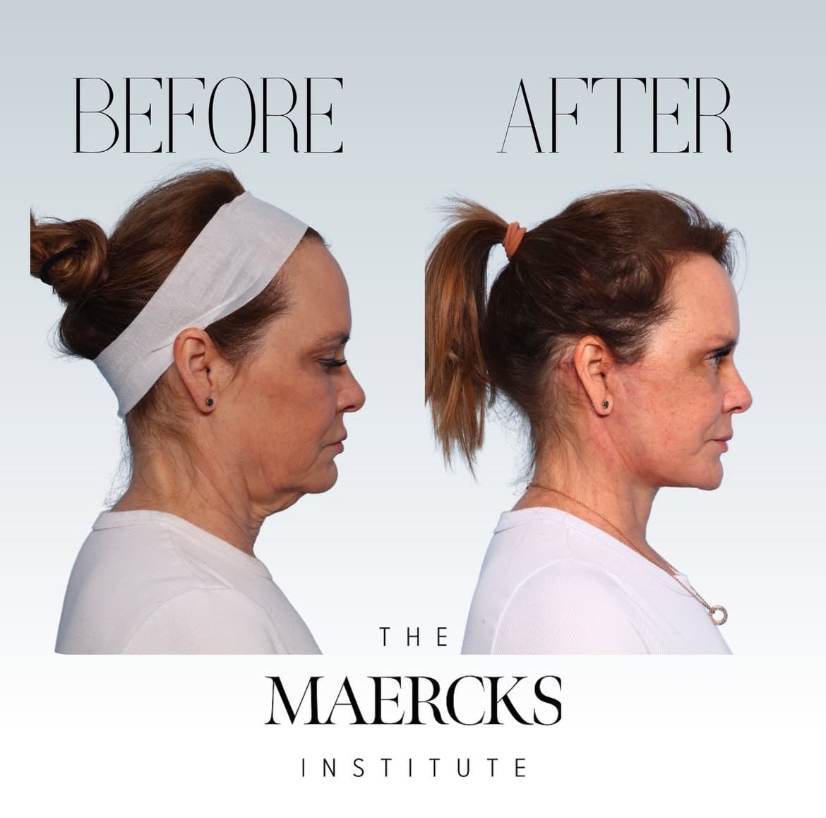 DRianMD's tweet photo. Precision meets perfection—another chin adjustment and Facelifts in the books! Transforming confidence, one procedure at a time. #Aestheticsurgery #MinimalDowntime #MaercksLift #FacialSculpting https://t.co/U9gC3YUcM5