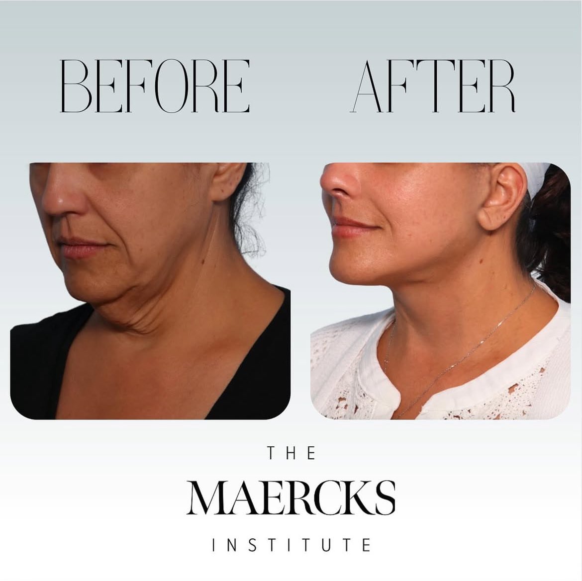 DRianMD's tweet photo. Precision meets perfection—another chin adjustment and Facelifts in the books! Transforming confidence, one procedure at a time. #Aestheticsurgery #MinimalDowntime #MaercksLift #FacialSculpting https://t.co/U9gC3YUcM5