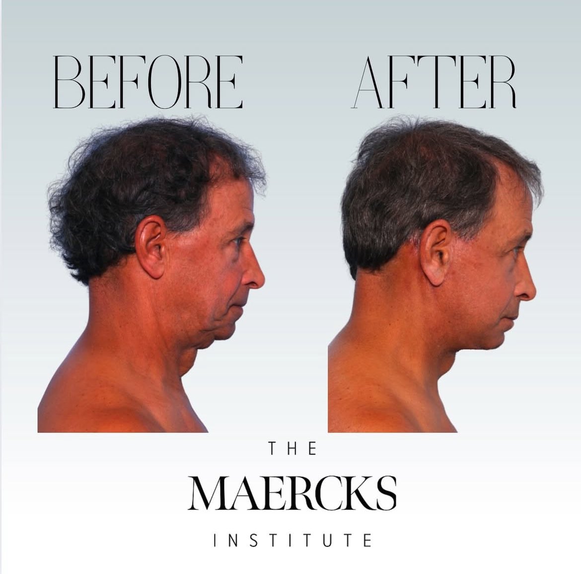 DRianMD's tweet photo. Precision meets perfection—another chin adjustment and Facelifts in the books! Transforming confidence, one procedure at a time. #Aestheticsurgery #MinimalDowntime #MaercksLift #FacialSculpting https://t.co/U9gC3YUcM5