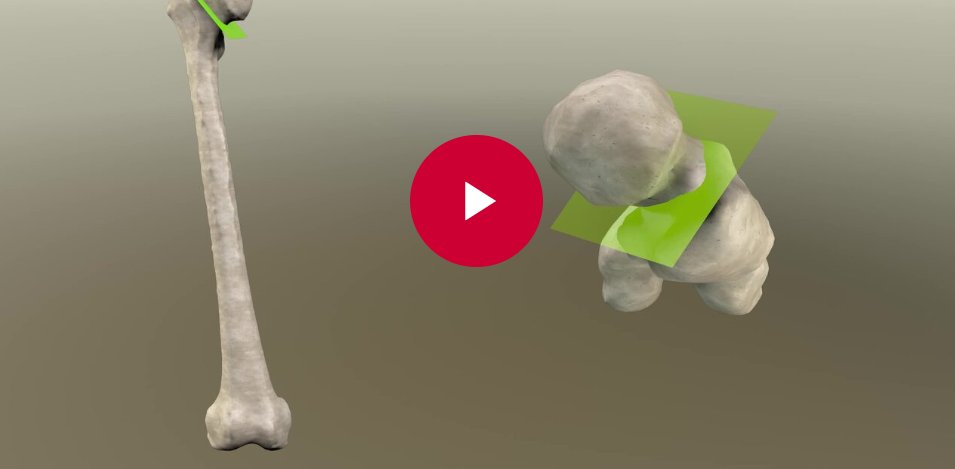 AAOS (@aaos1) on Twitter photo Celebrating #AAOS2025 #OVT Awards! Total #Hip #Arthroplasty with #Femoral Shortening and Rotational #Osteotomy by Direct Anterior Approach in
CROWE IV Hip Patients: bit.ly/4l4bnor
1700 #surgicaltechnique videos!
<a href="/CesareFaldini/">Cesare Faldini</a> <a href="/IRCCS_Rizzoli/">Rizzoli IRCCS</a>
#OVTFridays #CME #THA Celebrating #AAOS2025 #OVT Awards! Total #Hip #Arthroplasty with #Femoral Shortening and Rotational #Osteotomy by Direct Anterior Approach in
CROWE IV Hip Patients: bit.ly/4l4bnor
1700 #surgicaltechnique videos!
<a href="/CesareFaldini/">Cesare Faldini</a> <a href="/IRCCS_Rizzoli/">Rizzoli IRCCS</a>
#OVTFridays #CME #THA