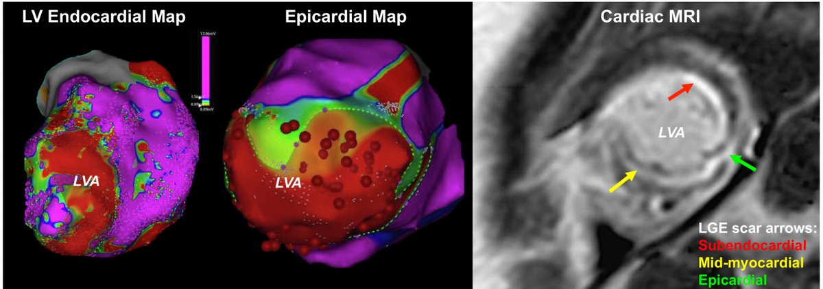 Pasquale Santangeli (@dr_santangeli) on Twitter photo Substrate Characterization and Outcomes of Catheter Ablation of VT in Patients with Non-Ischemic Dilated Cardiomyopathy and Isolated Apical Scar heartrhythmjournal.com/article/S1547-… <a href="/hrs_journal/">HeartRhythm</a> <a href="/CleClinicHVTI/">Cleveland Clinic Heart, Vascular & Thoracic</a> Substrate Characterization and Outcomes of Catheter Ablation of VT in Patients with Non-Ischemic Dilated Cardiomyopathy and Isolated Apical Scar heartrhythmjournal.com/article/S1547-… <a href="/hrs_journal/">HeartRhythm</a> <a href="/CleClinicHVTI/">Cleveland Clinic Heart, Vascular & Thoracic</a>