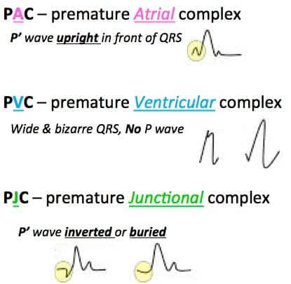 ZHeart11768530's tweet photo. 🔴 ECG Basics : Premature Complexes⤵️
🔹PACs
🔹PJCs
🔹PVCs
#EKG #Multifocal #ECG #Cardiology #MAT #Atrial #Tachycardia #Diagnosis #comparison #electrocardiogram #Arrhythmias #ekg #clinical #ekg #diagnosis #tachycardia #cardiology #rhythm https://t.co/WJ8ud12PIb