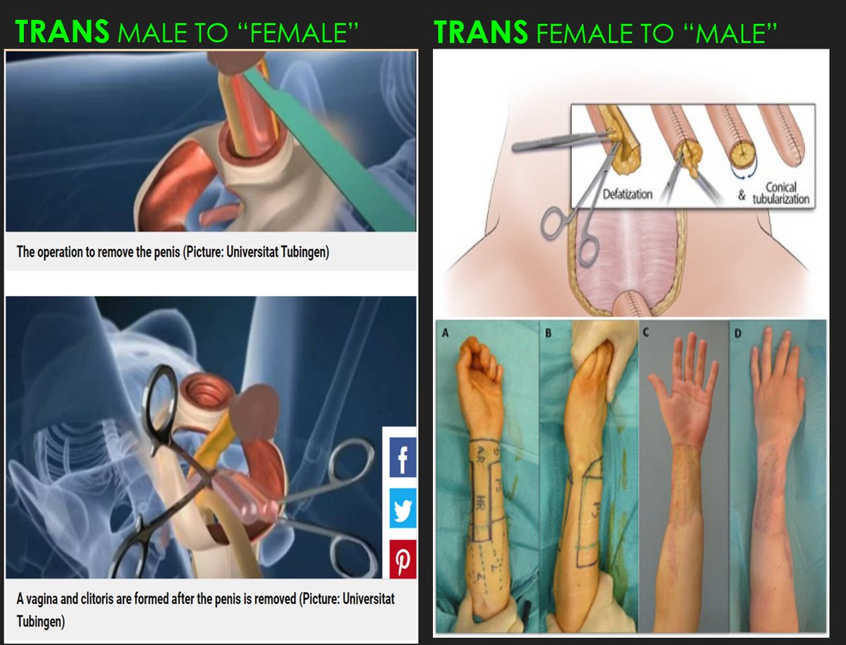 MujeresporPR's tweet photo. 1️⃣Sexualistas+prensa falsaria+"ciencia" corrompida+depravada EN BROTE por aprobación en el @SenadoPR #SíAlps0350
Vamos a hilo🧵de4️⃣:
1. No existen menores de edad "trans"
2. Hay menores de edad confundidos=disforia de identidad
3. Lo que hay es MUTILACIÓN DE NIÑEZ
Continúa↓ https://t.co/L23Odgki0z