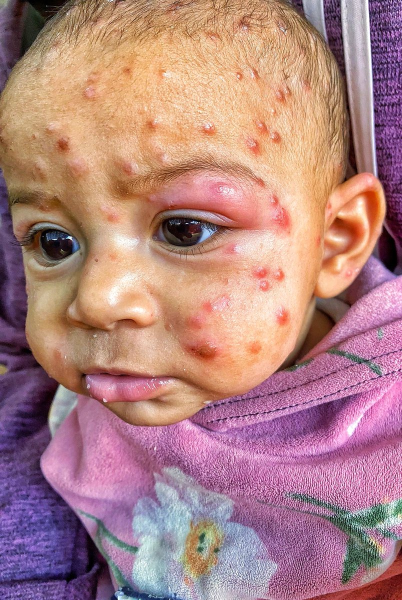 mahmoud60013's tweet photo. Tasneem is the most precious thing I have. I can't see her silent pain. Her little eye is swollen and filled with tears, and the pain follows her every moment. Her face is covered with pimples, spreading quickly through her body. Tasneem can no longer sleep. The weather is making her condition worse, and her eye, which aches and burns, can hardly find rest. Tasneem needs urgent treatment. Treatment is expensive
https://t.co/V6tQBtnlan