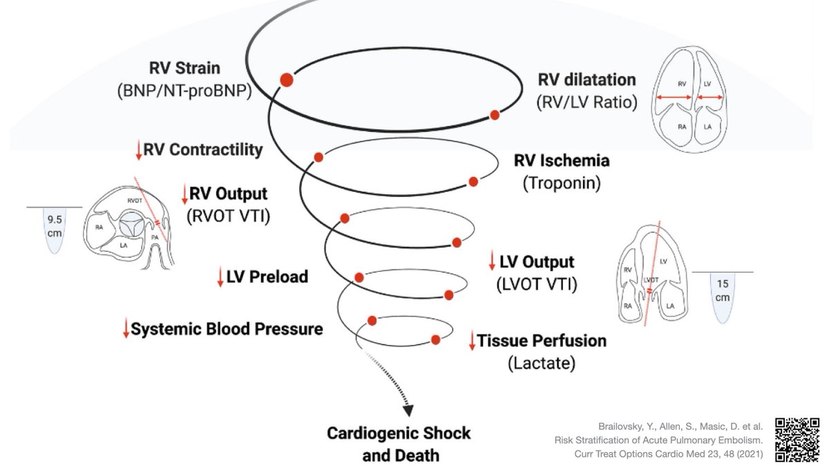 Cliff Reid (@cliffreid) on Twitter photo Fabulous schematic of the RV failure spiral in pulmonary embolism explaining the generation of laboratory and #POCUS findings as things increasingly go to shit
Thanks <a href="/NephroP/">NephroPOCUS</a> for finding this 👊
from link.springer.com/article/10.100… Fabulous schematic of the RV failure spiral in pulmonary embolism explaining the generation of laboratory and #POCUS findings as things increasingly go to shit
Thanks <a href="/NephroP/">NephroPOCUS</a> for finding this 👊
from link.springer.com/article/10.100…