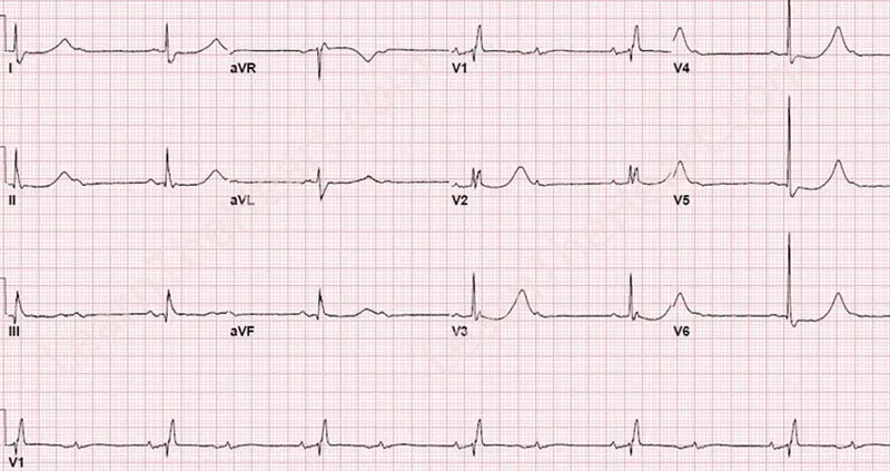 LearntheHeart's tweet photo. #ECGoftheWeek
Which of the following does this ECG represent?
A. Normal sinus rhythm
B. 2:1 atrioventricular nodal block
C. Right bundle branch block
D. All of the above
Cast your vote below and check back Tuesday for the answer! https://t.co/Ddr7ZbViV6
