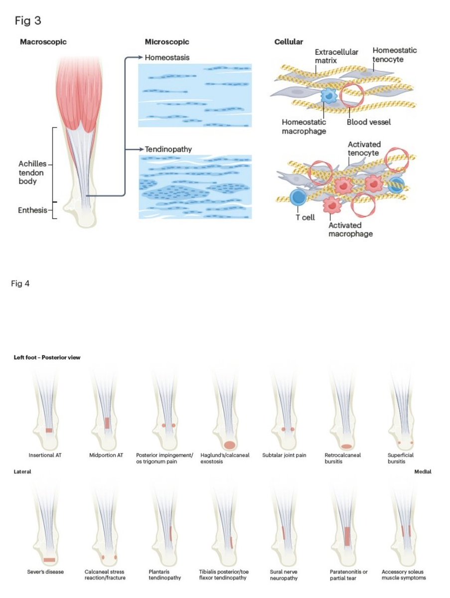 DavidMackeyDPT's tweet image. Achilles tendinopathy 🦶🏼
▪️Epidemiology
▪️Mechanisms/pathophysiology 
▪️Diagnosis and differential diagnosis
▪️Prevention 
▪️Management
Traweger et al. (2025)
ora.ox.ac.uk/objects/uuid:1…
