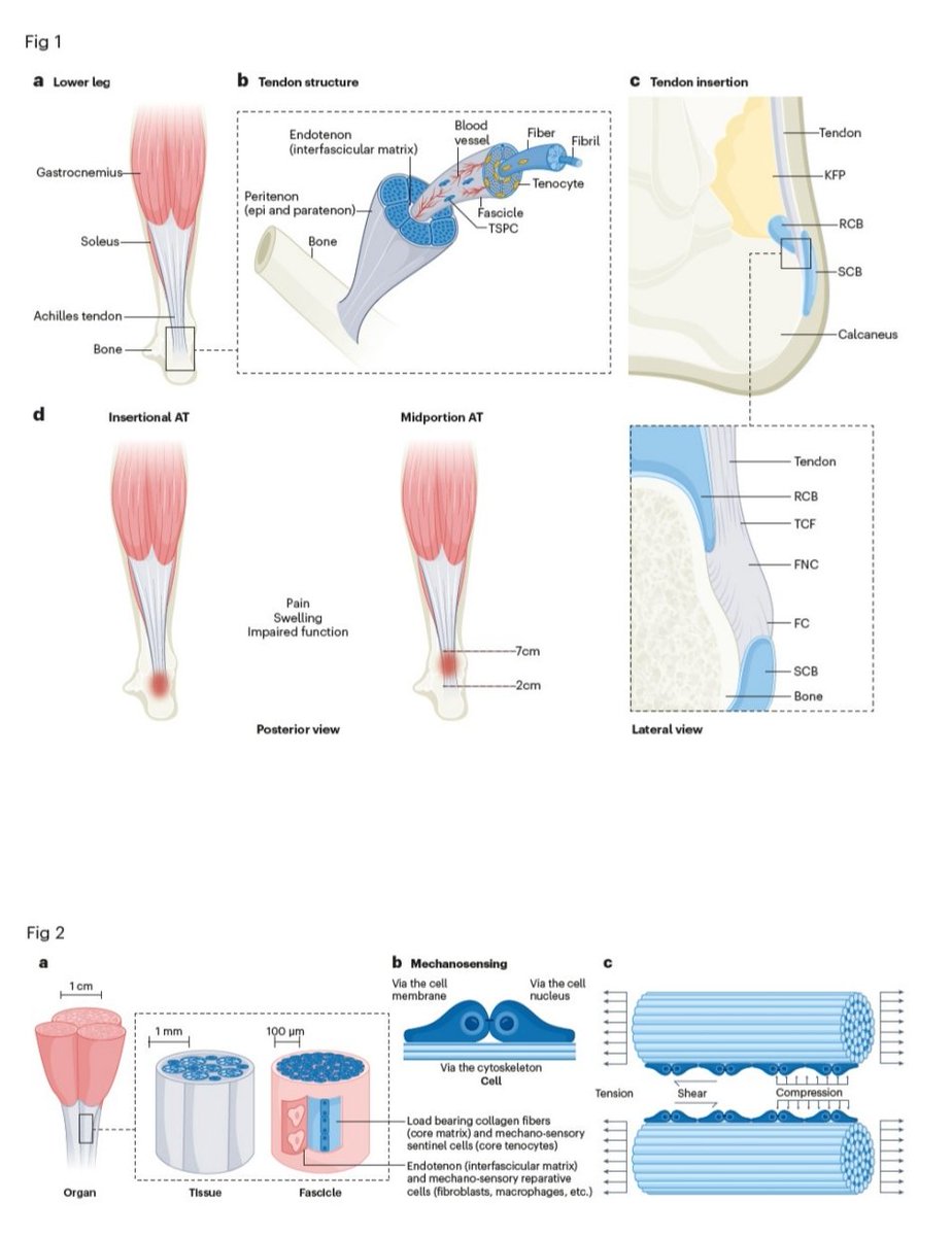 DavidMackeyDPT's tweet image. Achilles tendinopathy 🦶🏼
▪️Epidemiology
▪️Mechanisms/pathophysiology 
▪️Diagnosis and differential diagnosis
▪️Prevention 
▪️Management
Traweger et al. (2025)
ora.ox.ac.uk/objects/uuid:1…