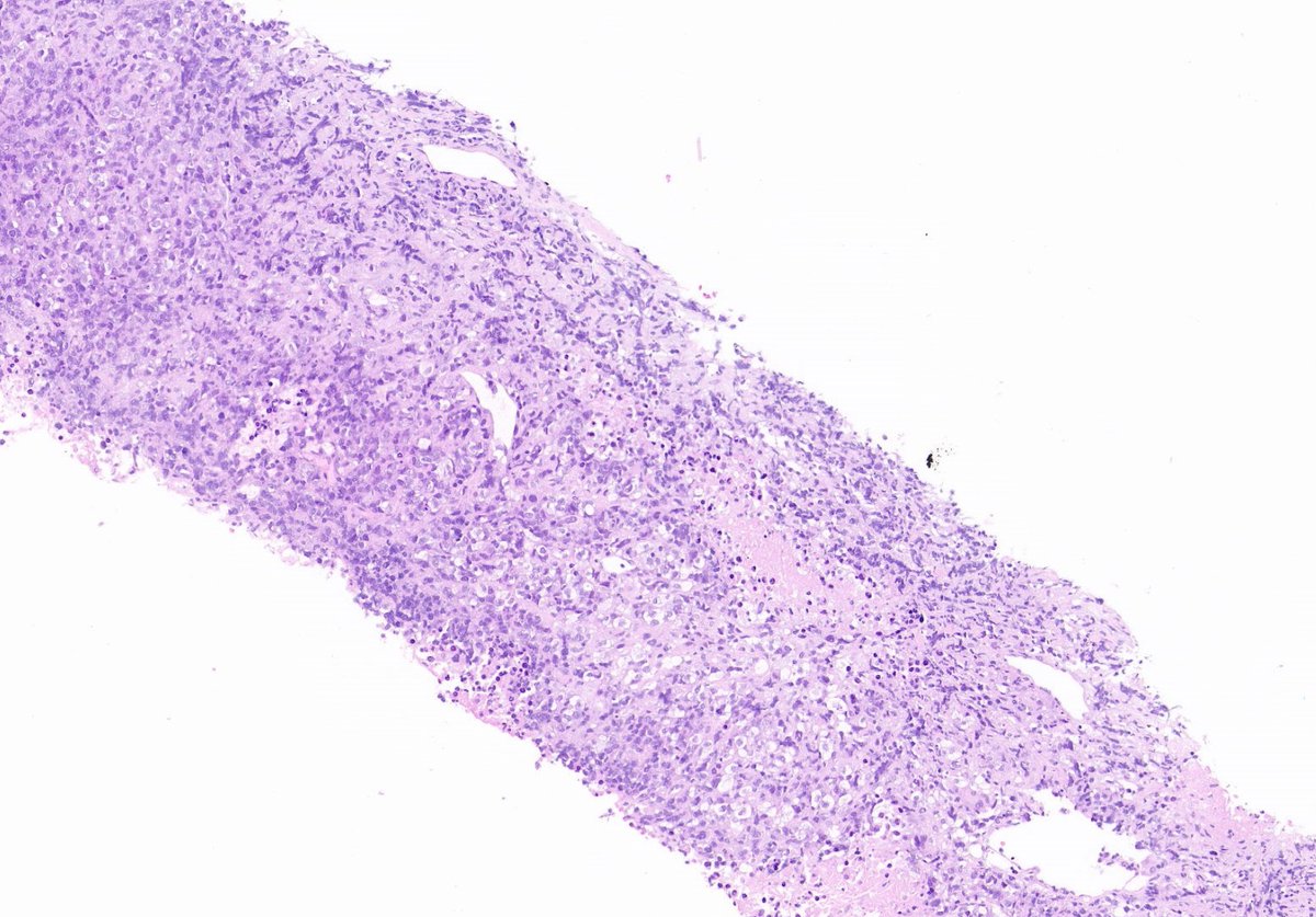 TristanRutland7's tweet photo. Abdomen, older male

#GIpath #GUpath #BSTpath #pathtwitter #Pathresidents https://t.co/EpESGetok5