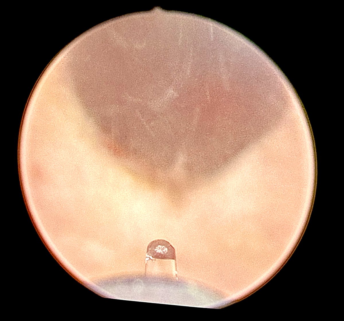 Amy Krambeck (@amy_krambeck) on Twitter photo Over the last 36 months this individual underwent robotic waterjet therapy then 2 TURPs and resumed his BPH meds for persistent LUTs and hematuria. This week he underwent HoLEP to hopefully end the BPH journey. <a href="/NM_Urology/">NM Urology</a> <a href="/EndourologyNm/">NM_Endourology</a> Over the last 36 months this individual underwent robotic waterjet therapy then 2 TURPs and resumed his BPH meds for persistent LUTs and hematuria. This week he underwent HoLEP to hopefully end the BPH journey. <a href="/NM_Urology/">NM Urology</a> <a href="/EndourologyNm/">NM_Endourology</a>