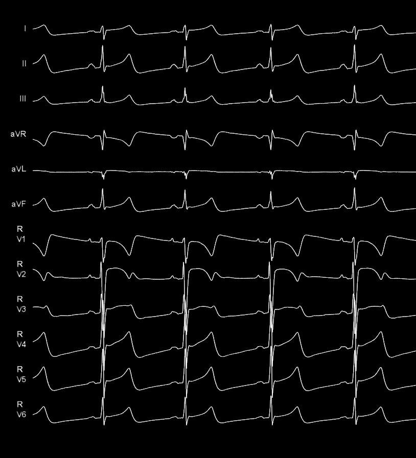 Andreas Müssigbrodt (@epwavedoc) on Twitter photo Interesting #fluoroless ablation of a anteroseptal/ parahisian accessory pathway in 15 yo symptomatic athlete. Mapping and differential pacing revealed an oblique course with septal atrial and anterior/anterolateral ventr insertion <a href="/CHUM972/">CHU de Martinique</a> <a href="/RomainVergier/">Vergier Romain</a>
x.com/epwavedoc/stat… Interesting #fluoroless ablation of a anteroseptal/ parahisian accessory pathway in 15 yo symptomatic athlete. Mapping and differential pacing revealed an oblique course with septal atrial and anterior/anterolateral ventr insertion <a href="/CHUM972/">CHU de Martinique</a> <a href="/RomainVergier/">Vergier Romain</a>
x.com/epwavedoc/stat…