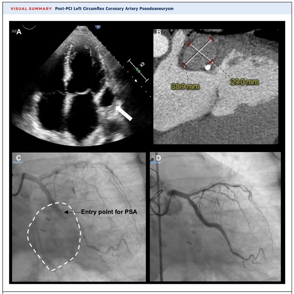 Andrea Scotti (@andreascotti21) on Twitter photo Check this complex case of LCx Pseudoaneurysm
💡Good learning points for Complication Diagnosis, Management, and Prevention!
🔗 doi.org/10.1016/j.jacc…
<a href="/Antonellamillin/">Antonella</a> <a href="/MatteoSturlaM/">Matteo Sturla</a> <a href="/azeemlatib/">Azeem Latib</a> <a href="/MonteHeart/">Montefiore Heart</a>
<a href="/GilbertTangMD/">Dr. Gilbert Tang</a> <a href="/JACCJournals/">JACC Journals</a>
<a href="/MontefioreNYC/">Montefiore Health System</a> <a href="/EinsteinMed/">Albert Einstein College of Medicine - Official</a> Check this complex case of LCx Pseudoaneurysm
💡Good learning points for Complication Diagnosis, Management, and Prevention!
🔗 doi.org/10.1016/j.jacc…
<a href="/Antonellamillin/">Antonella</a> <a href="/MatteoSturlaM/">Matteo Sturla</a> <a href="/azeemlatib/">Azeem Latib</a> <a href="/MonteHeart/">Montefiore Heart</a>
<a href="/GilbertTangMD/">Dr. Gilbert Tang</a> <a href="/JACCJournals/">JACC Journals</a>
<a href="/MontefioreNYC/">Montefiore Health System</a> <a href="/EinsteinMed/">Albert Einstein College of Medicine - Official</a>