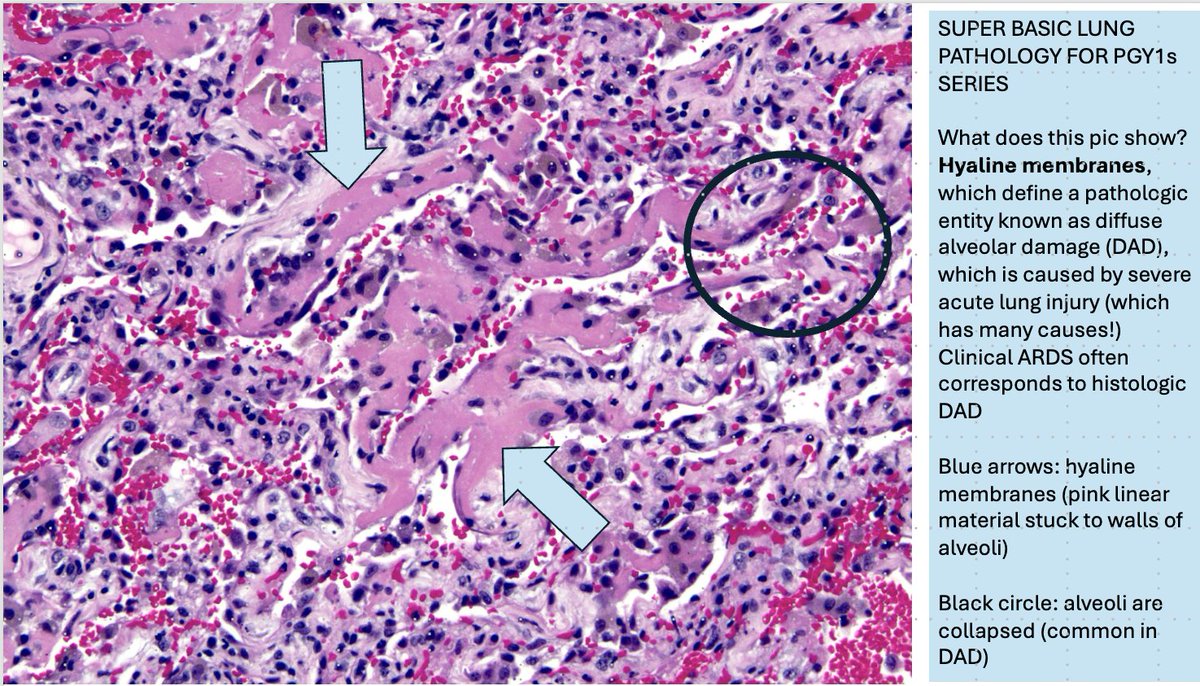 48. PGY1s: you will see this entity commonly in autopsies and occasionally in lung biopsies: it's called diffuse alveolar damage (DAD). To diagnose it, you need to know what hyaline membranes look like. They are labeled with arrows!

 #pathology #pulmpath #sblppgy1s