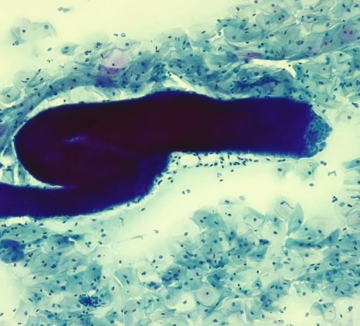 Citopatoroxx's tweet image. It is only a lower uterine segment sampling with characteristic tubular structure, and it&apos;s beautiful. 

#cytopath #paptest