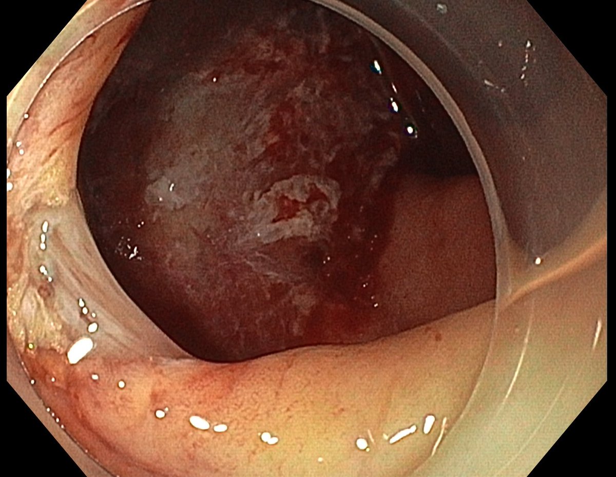 LuDERG (@l_uderg) on Twitter photo We have included the tenth patient for "Cold Snare Endoscopic Mucosal Resection of Duodenal Adenomas > 10 mm: A prospective cohort study ".
The primary objective of this study is to evaluate the efficacy of CS-EMR for the resection of adenomatous duodenal polyps.
<a href="/GI_UMCLJ/">Gastroenterology Department UMC LJUBLJANA</a> We have included the tenth patient for "Cold Snare Endoscopic Mucosal Resection of Duodenal Adenomas > 10 mm: A prospective cohort study ".
The primary objective of this study is to evaluate the efficacy of CS-EMR for the resection of adenomatous duodenal polyps.
<a href="/GI_UMCLJ/">Gastroenterology Department UMC LJUBLJANA</a>