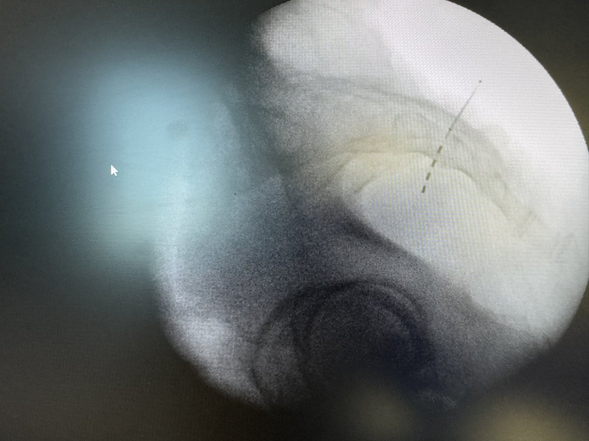 Simone Pletto (@lomplet) on Twitter photo Truly excited about this session. Two #sacralneuromodulation PNE at <a href="/ptvonline2001/">Policlinico Tor Vergata</a> to treat #OAB and Idiopathic non obstructive retention (#NOR).
Thanks to the whole team end Prof <a href="/EFinazziAgro/">Enrico Finazzi Agrò</a> Truly excited about this session. Two #sacralneuromodulation PNE at <a href="/ptvonline2001/">Policlinico Tor Vergata</a> to treat #OAB and Idiopathic non obstructive retention (#NOR).
Thanks to the whole team end Prof <a href="/EFinazziAgro/">Enrico Finazzi Agrò</a>