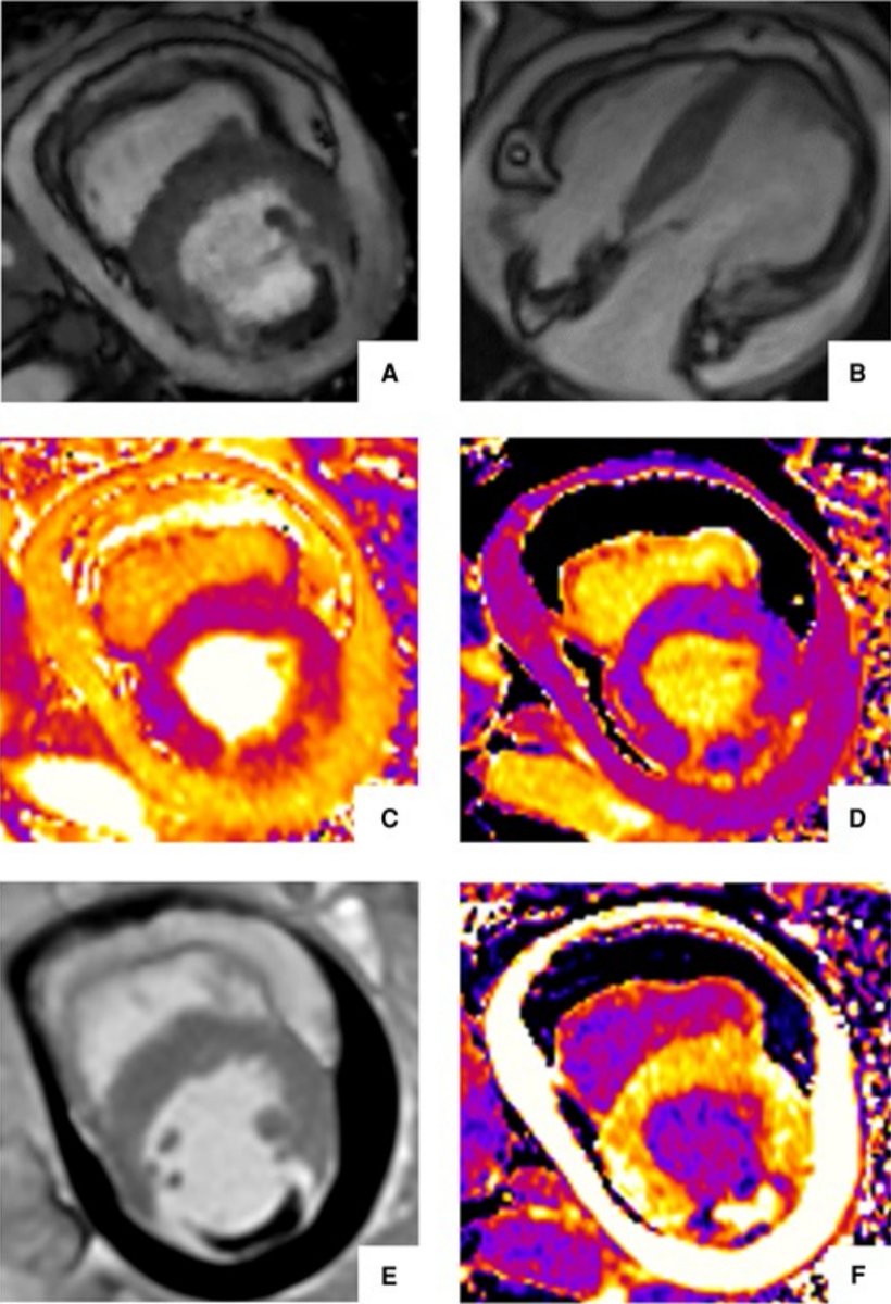 European Society of Cardiology Journals (@esc_journals) on Twitter photo Challenge yourself through a clinical case - check out the new #SpotTheDiagnosis in #EHJACVC ow.ly/Tci550Vt81U
<a href="/EHJACVCEiC/">EHJACVC Editor-in-Chief</a> <a href="/ACVCPresident/">ACVCPresident</a> <a href="/drmilicaa/">Milica Aleksic</a> <a href="/ann_oleksiak/">Anna Oleksiak, MD PhD</a> <a href="/maria_bergami/">Maria Bergami, MD, PhD</a> Challenge yourself through a clinical case - check out the new #SpotTheDiagnosis in #EHJACVC ow.ly/Tci550Vt81U
<a href="/EHJACVCEiC/">EHJACVC Editor-in-Chief</a> <a href="/ACVCPresident/">ACVCPresident</a> <a href="/drmilicaa/">Milica Aleksic</a> <a href="/ann_oleksiak/">Anna Oleksiak, MD PhD</a> <a href="/maria_bergami/">Maria Bergami, MD, PhD</a>