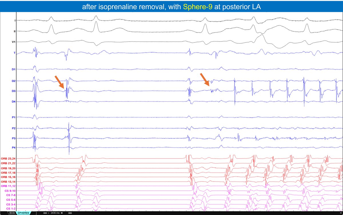 Paroxysmal AF in a young patient... still symptomatic months after PVI... no wonder... elicited reproducible posterior left atrium AF TRIGGER, recorded and terminated using Sphere-9 (Affera) 🤖 see 👇🧵