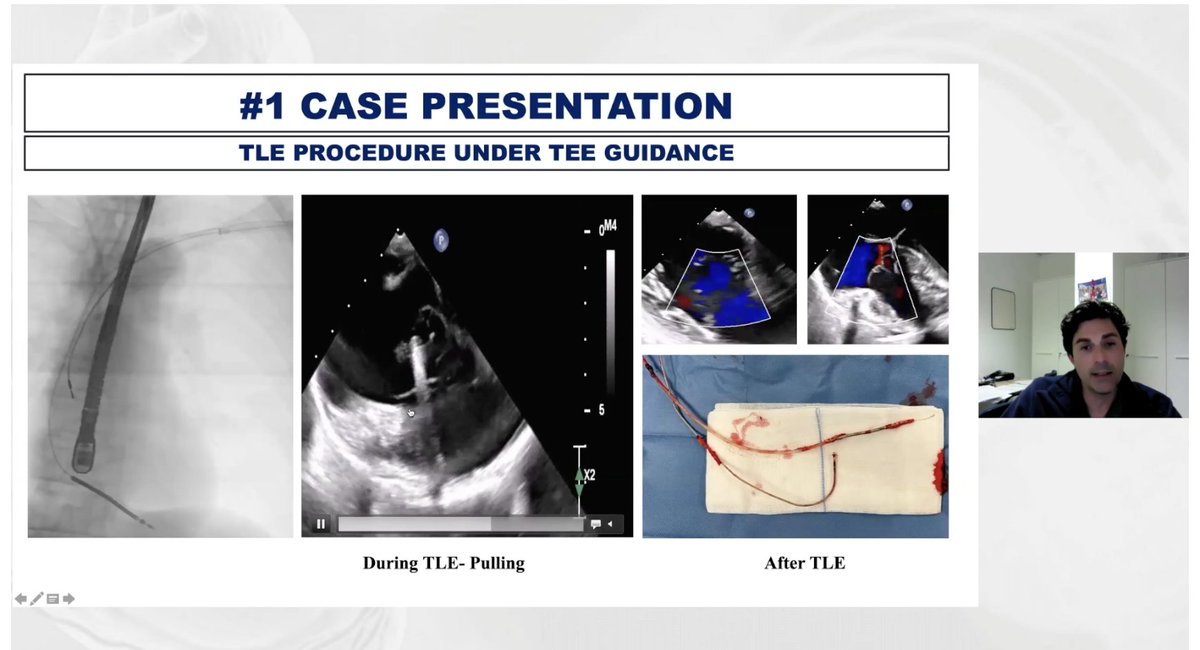 Edward J Schloss MD (@ejsmd) on Twitter photo .<a href="/Fede79Miglio/">Federico Migliore</a> -
How to avoid TV lead damage during lead extraction?
Use multimodality imaging
✳️CT Before -- look for calcification, adherence)
✳️TEE during -- avoid excessive traction if TV is involved
#TALES2025
#EPeeps .<a href="/Fede79Miglio/">Federico Migliore</a> -
How to avoid TV lead damage during lead extraction?
Use multimodality imaging
✳️CT Before -- look for calcification, adherence)
✳️TEE during -- avoid excessive traction if TV is involved
#TALES2025
#EPeeps