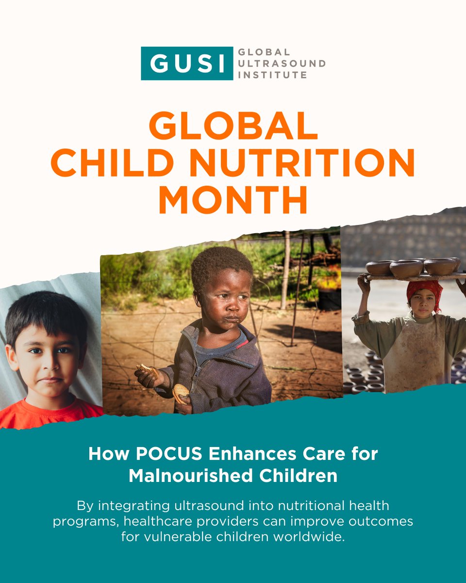 🩺 POCUS: A game-changer for child malnutrition care! 

🔎 Detects muscle wasting &amp; fat loss
🫁 Diagnoses pneumonia &amp; dehydration
⚕️ Monitors nutritional recovery

In low-resource settings, real-time ultrasound saves lives.