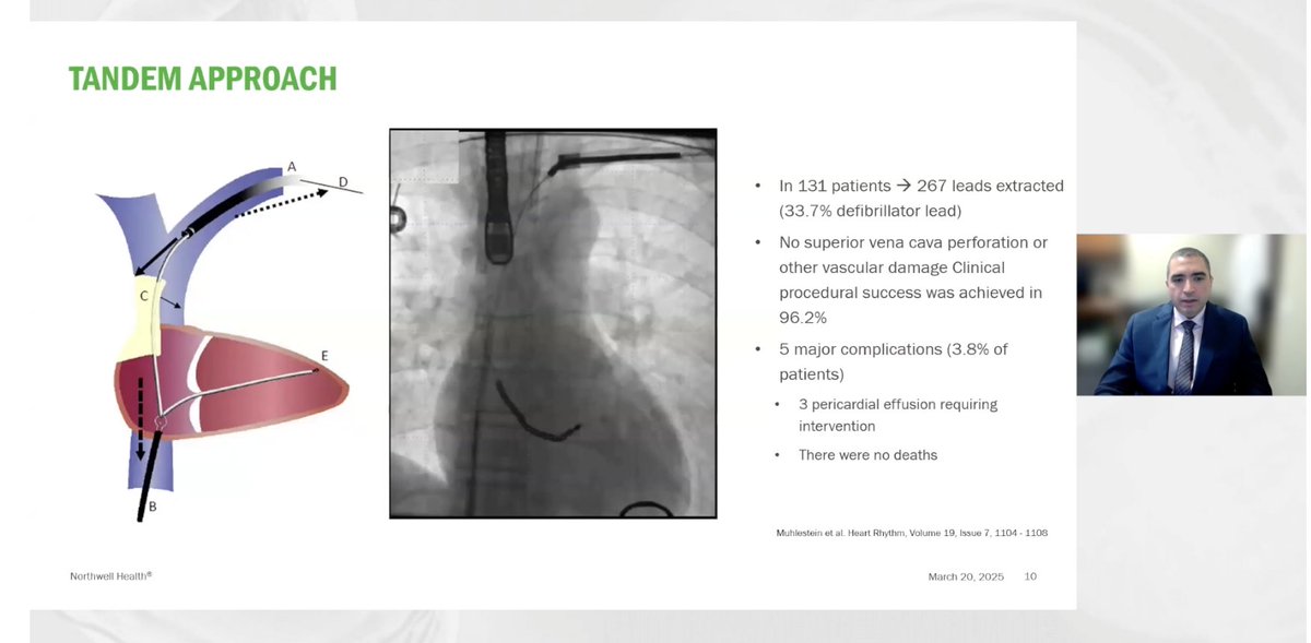 Edward J Schloss MD (@ejsmd) on Twitter photo .<a href="/hisbundle/">Moussa Saleh</a>
Tandem approach provides a reliable rail and decreases risk of SVC perforation.
#TALES2025
#EPeeps .<a href="/hisbundle/">Moussa Saleh</a>
Tandem approach provides a reliable rail and decreases risk of SVC perforation.
#TALES2025
#EPeeps